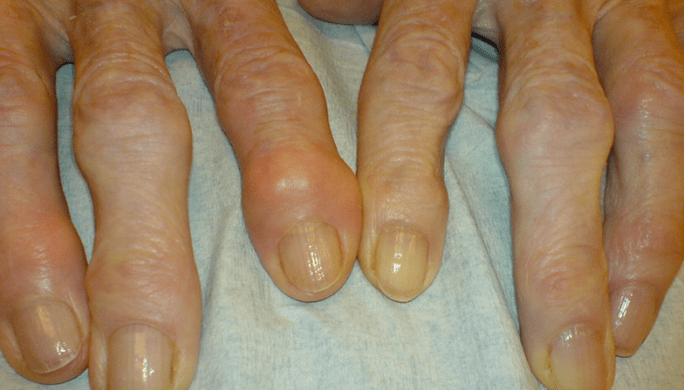 Pain in finger joints with osteoarthritis