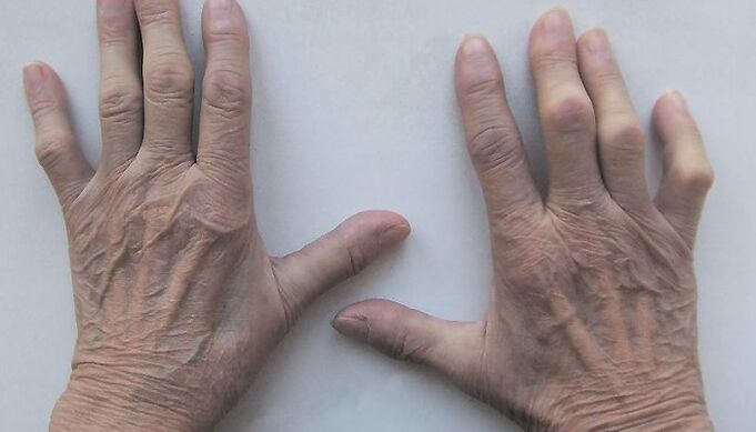 Pain in finger joints