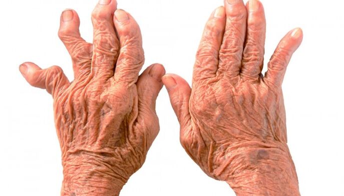 Rheumatoid arthritis as a cause of pain in finger joints
