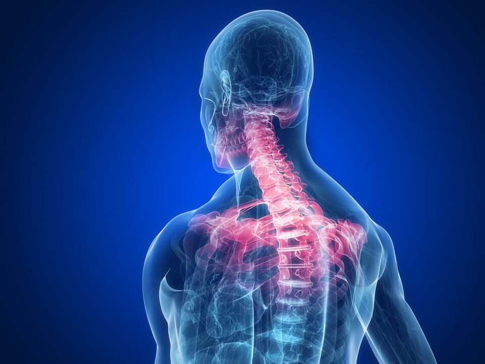 Spondyloarthrosis as a cause of pain among shoulder blades