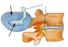 Destruction of the fibrous ring during cervical osteochondrosis