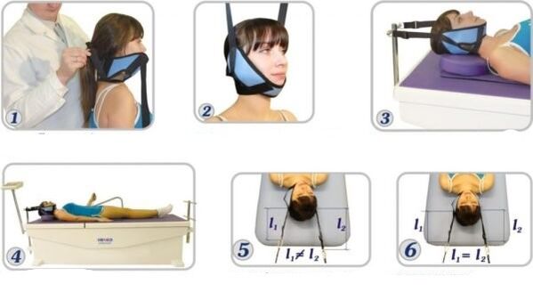Treatment of cervical osteochondrosis using traction