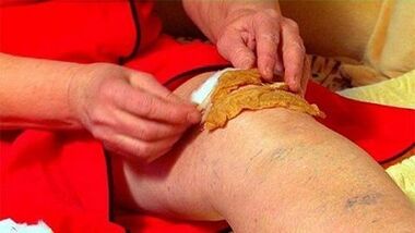 Compresses for knee joint arthrosis