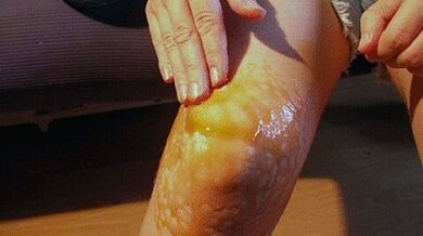 Knee to treat the knee joint arthrosis
