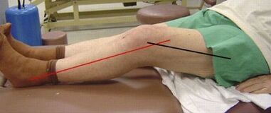 Progressive arthritis of the knee joint