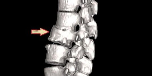 Spinal pathology as a cause of spinal pain