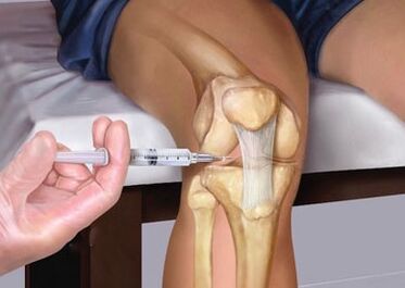 Injection to the joint