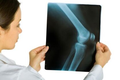 Treatment of knee joint arthrosis
