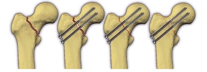 Fixation of the bone body with pins during femoral joint pain