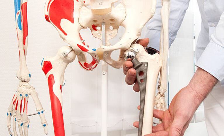 Thigh arthroplasty for pain