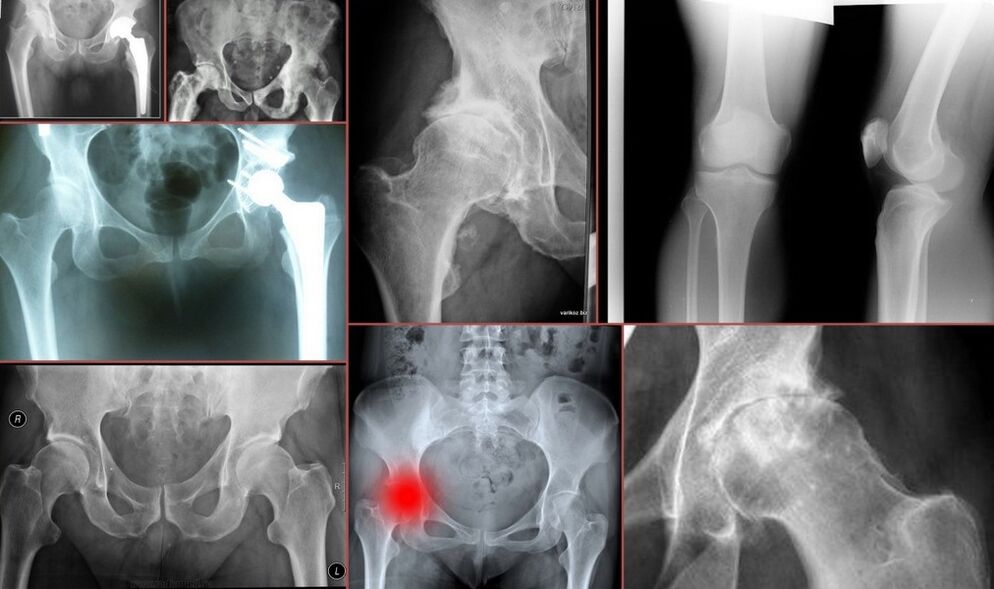 X-ray for thigh pain