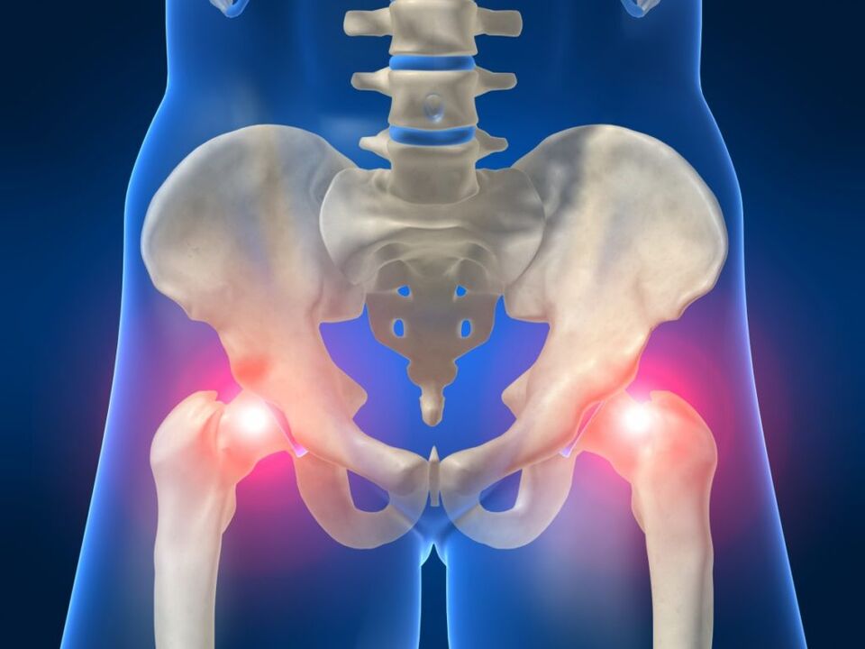 Ankylosing spondylitis is a disturbing bilateral pain in the femoral joint