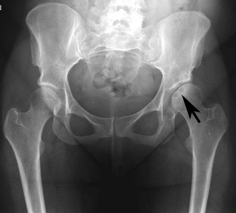 Deposition of calcium salts in the femoral joint by pseudogene X-ray