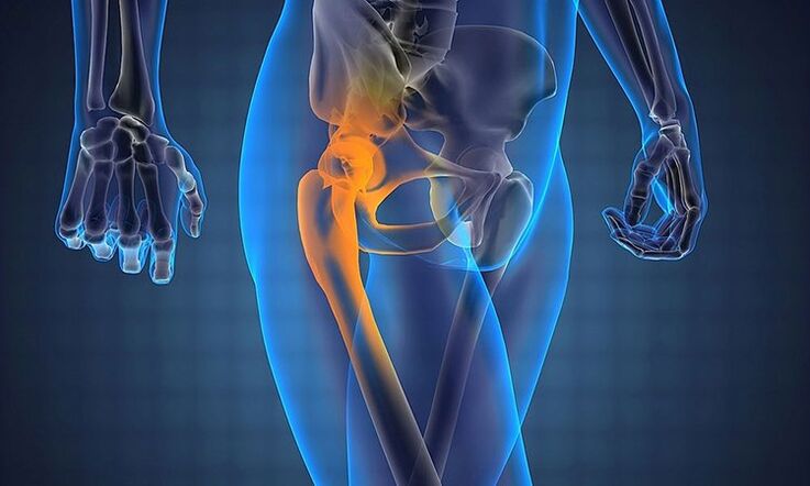 Pain in the femoral joint